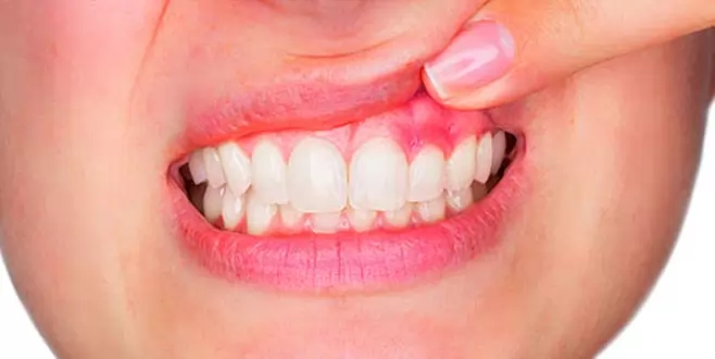 Diş Kökü İltihabı Nedir?